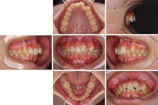 【モニター】下顎前歯の2本欠損　上顎のみの抜歯でバランスを取ったワイヤー矯正 治療前画像