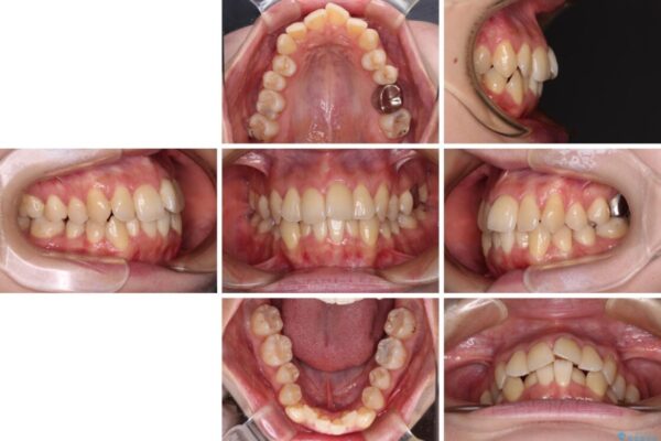【モニター】急速拡大装置　狭い歯列を拡大してワイヤー装置で短期間治療 治療前画像