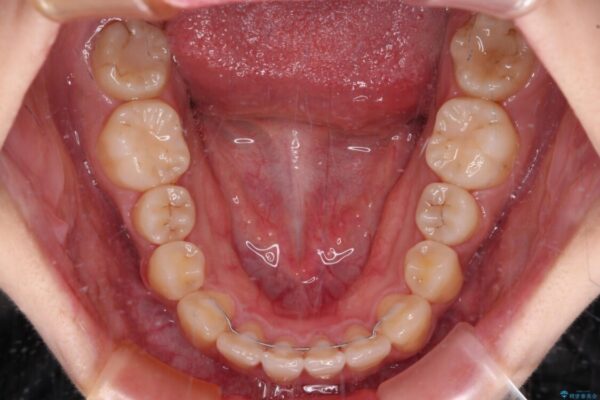 【モニター】捻れた前歯をスッキリと　インビザライン矯正治療 治療後画像