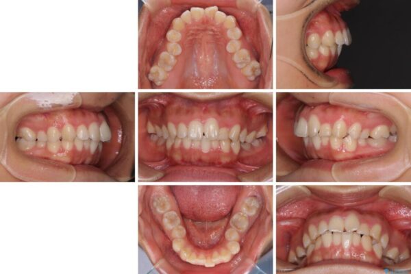 【モニター】閉じにくい口元　ワイヤー装置での抜歯矯正 治療前画像