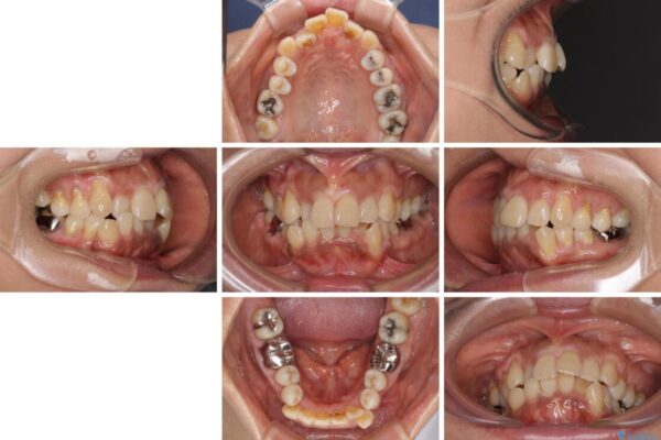 クロスバイトの前歯を治したい　ワイヤー装置でも抜歯矯正 治療前画像