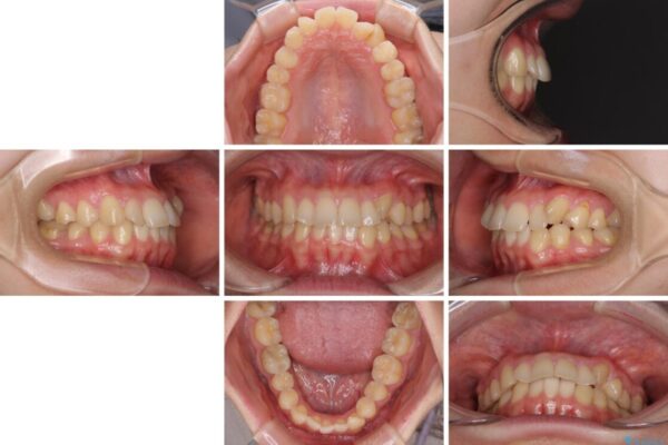 【モニター】1本欠損した下顎前歯と上顎の八重歯　ワイヤー装置で楽して矯正治療 治療前画像