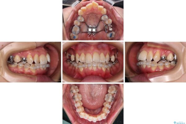 【モニター】急速拡大装置　狭い歯列を拡大してワイヤー装置で短期間治療 治療途中画像