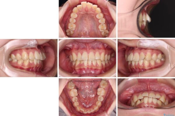 【モニター】捻れた前歯をスッキリと　インビザライン矯正治療 治療前画像