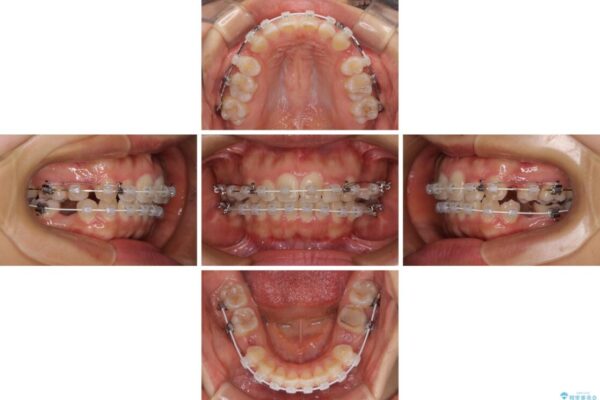 【モニター】閉じにくい口元　ワイヤー装置での抜歯矯正 治療途中画像
