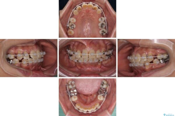 クロスバイトの前歯を治したい　ワイヤー装置でも抜歯矯正 治療途中画像