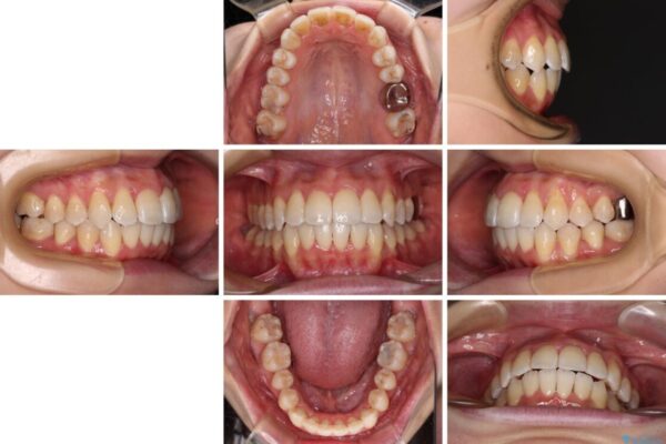 【モニター】急速拡大装置　狭い歯列を拡大してワイヤー装置で短期間治療 治療後画像