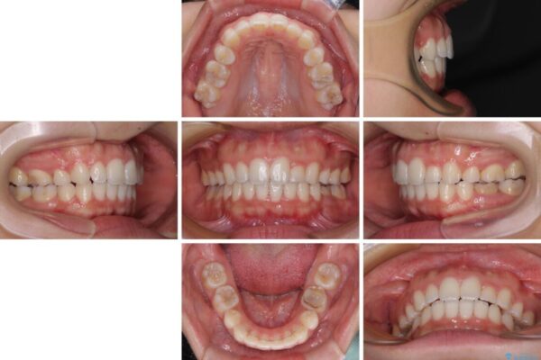 【モニター】閉じにくい口元　ワイヤー装置での抜歯矯正 治療後画像