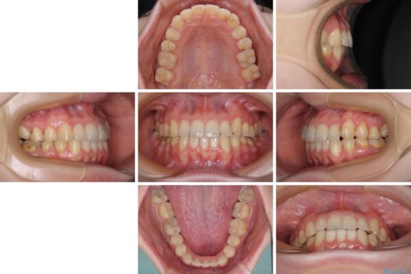 【モニター】1本欠損した下顎前歯と上顎の八重歯　ワイヤー装置で楽して矯正治療 治療後画像