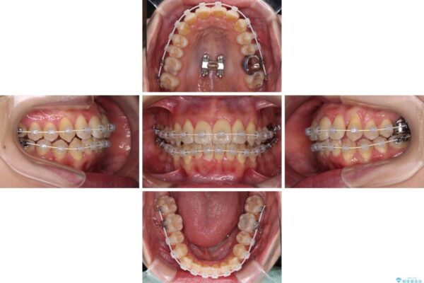 【モニター】急速拡大装置　狭い歯列を拡大してワイヤー装置で短期間治療 治療途中画像