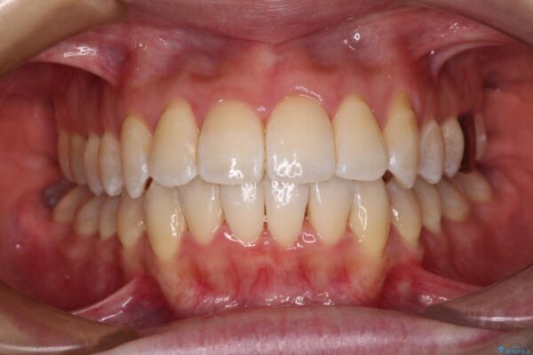 【モニター】急速拡大装置　狭い歯列を拡大してワイヤー装置で短期間治療 治療後画像