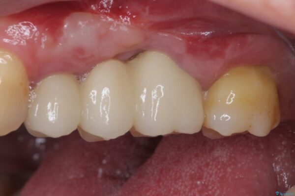 ものが挟まって痛む　割れてしまった歯のオールセラミックブリッジ治療 治療後画像