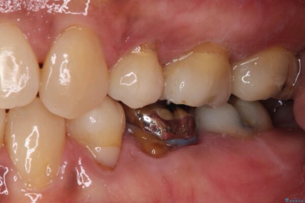 奥歯の銀歯をゴールドに 治療前画像