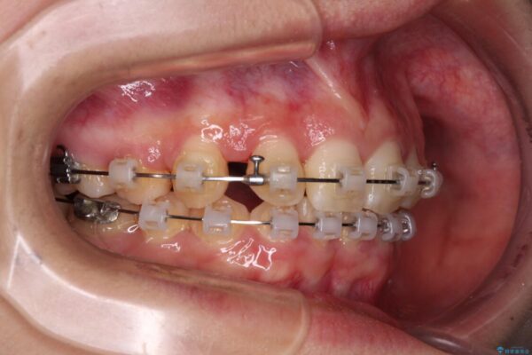 【モニター】下顎前歯の2本欠損　上顎のみの抜歯でバランスを取ったワイヤー矯正 治療途中画像
