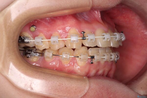 【モニター】1本欠損した下顎前歯と上顎の八重歯　ワイヤー装置で楽して矯正治療 治療途中画像