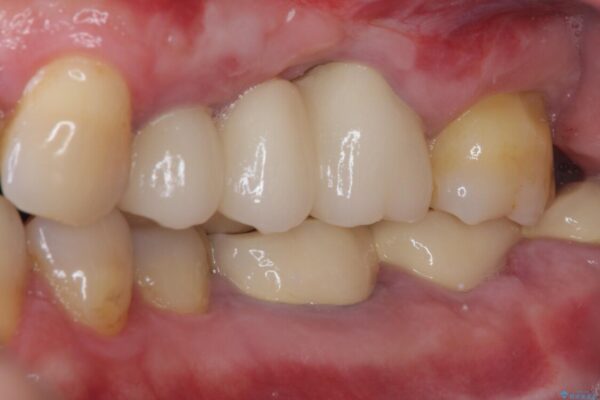 ものが挟まって痛む　割れてしまった歯のオールセラミックブリッジ治療 治療後画像