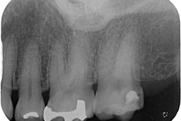 何度も外れてしまう銀歯　ゴールドインレーによる虫歯治療 治療前画像