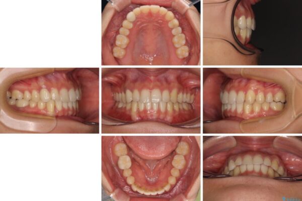 【モニター】下顎の気になる八重歯を改善　インビザラインによる矯正治療 治療後画像