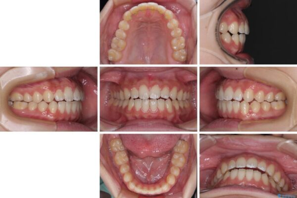 【モニター】隙間だらけの前歯を治したい　インビザラインによる矯正治療 治療後画像