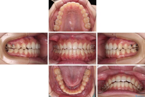 【モニター】隙間だらけの前歯を治したい　インビザラインによる矯正治療 治療途中画像