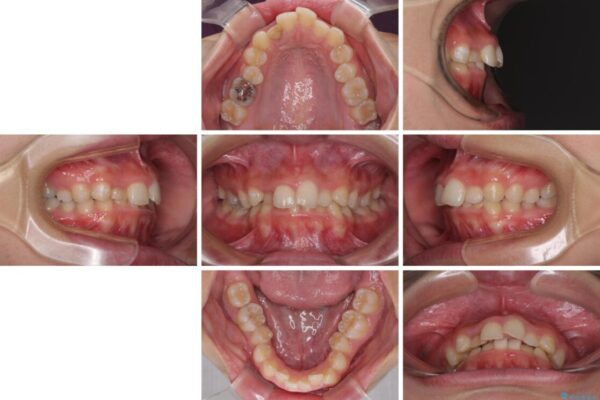 【モニター】前歯のデコボコと変色した前歯をインビザラインとオールセラミッククラウンで 治療前画像