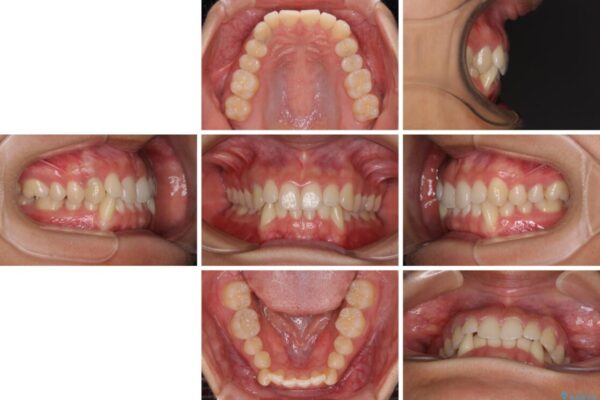 【モニター】下顎の気になる八重歯を改善　インビザラインによる矯正治療 治療前画像