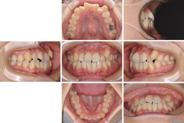 【モニター】前歯のデコボコを改善　ワイヤー矯正を併用したインビザライン矯正 治療前画像