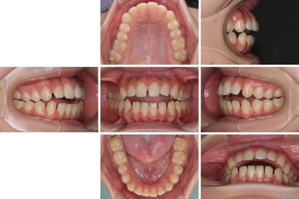 【モニター】隙間だらけの前歯を治したい　インビザラインによる矯正治療 治療前画像