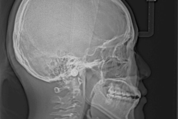 【モニター】隙間だらけの前歯を治したい　インビザラインによる矯正治療 治療後画像