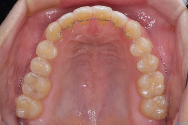 【モニター】隙間だらけの前歯を治したい　インビザラインによる矯正治療 治療後画像