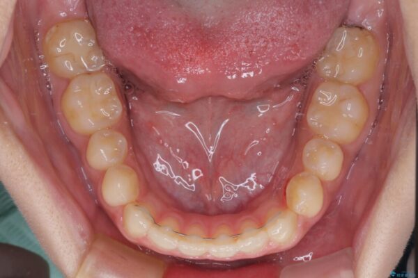 【モニター】隙間だらけの前歯を治したい　インビザラインによる矯正治療 治療後画像
