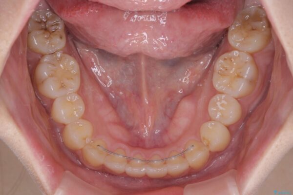 【モニター】前歯のデコボコを改善　ワイヤー矯正を併用したインビザライン矯正 治療後画像