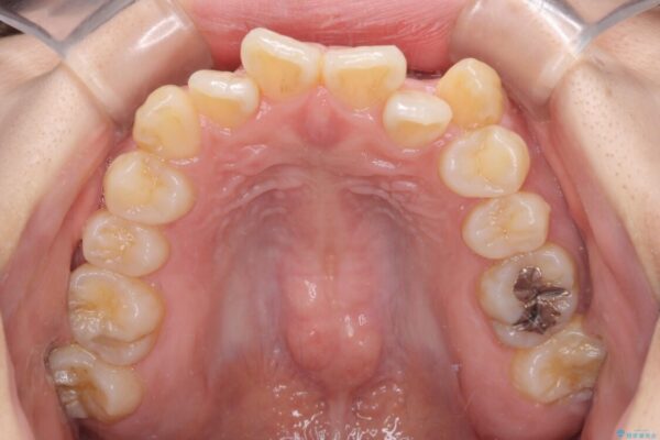 【モニター】前歯のデコボコを改善　ワイヤー矯正を併用したインビザライン矯正 治療前画像