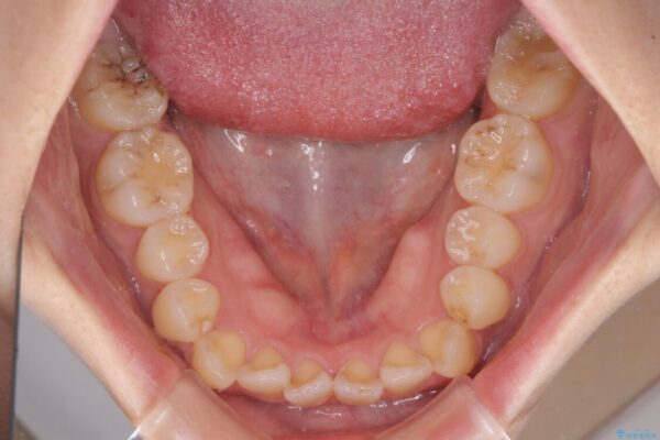 【モニター】前歯のデコボコを改善　ワイヤー矯正を併用したインビザライン矯正 治療前画像