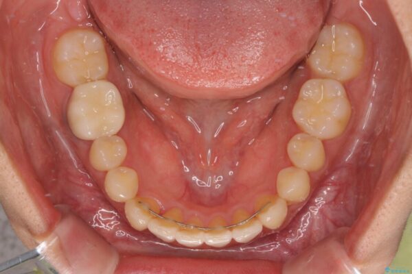 【モニター】下顎の気になる八重歯を改善　インビザラインによる矯正治療 治療後画像