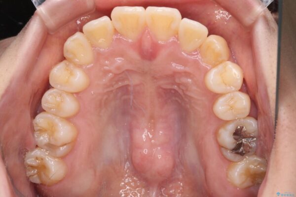 【モニター】前歯のデコボコを改善　ワイヤー矯正を併用したインビザライン矯正 治療途中画像