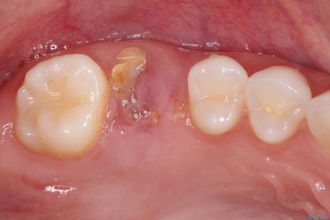 放置した奥歯の虫歯　インプラントによる欠損補綴治療 治療前