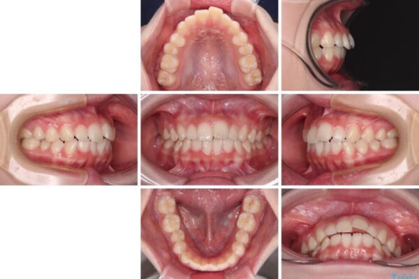 前歯のデコボコを治したい　高校生のインビザライン治療 治療前画像