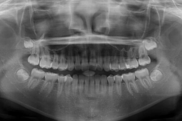 前歯のデコボコを治したい　高校生のインビザライン治療 治療前画像