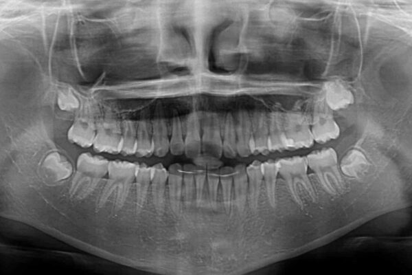 前歯のデコボコを治したい　高校生のインビザライン治療 治療後画像