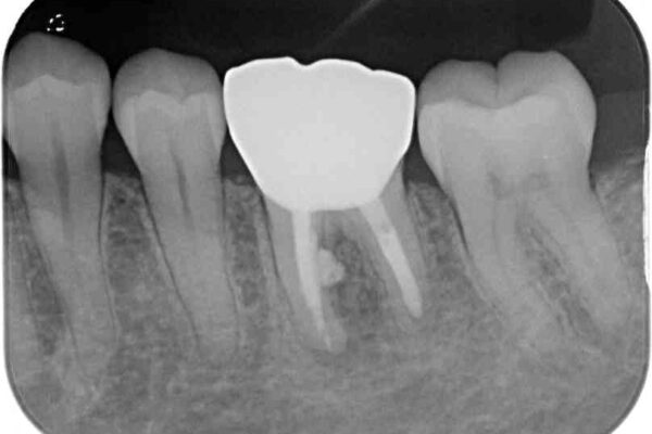 指摘された虫歯　オールセラミッククラウンによる補綴治療 治療後画像