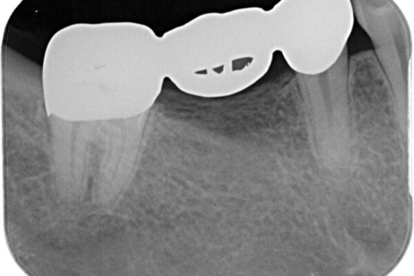 金属のブリッジをやり替えたい 治療前画像