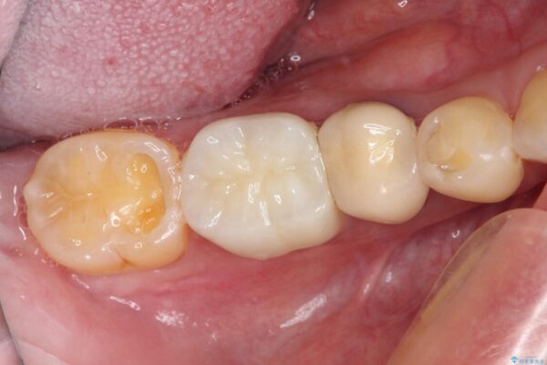 奥歯が欠けてしまった　オールセラミッククラウンによる補綴治療 アフター