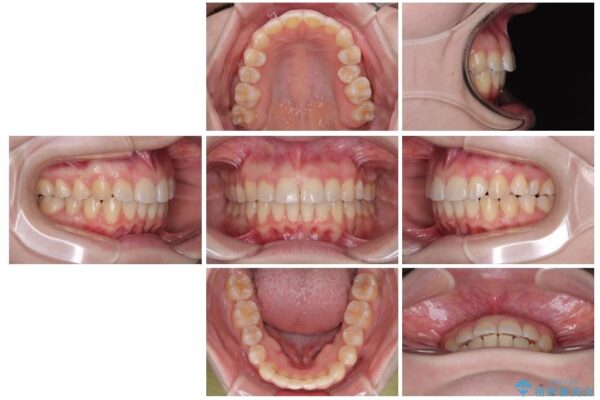 左上の前歯が出ているのが気になる　審美装置による非抜歯ワイヤー矯正 治療途中画像