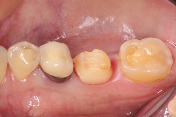 奥歯が欠けてしまった　オールセラミッククラウンによる補綴治療 治療途中画像