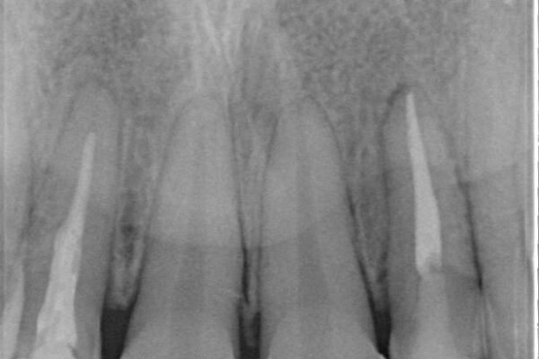 前歯をきれいにしたい　オールセラミッククラウンにによる補綴 治療前画像