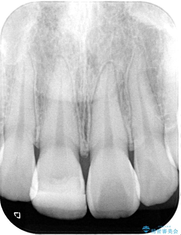 違和感のある前歯をセラミックにしたい 治療前