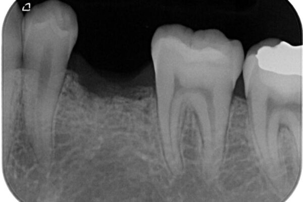永久歯の先天欠如　インプラントによる補綴 治療前画像
