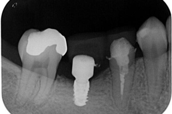 銀歯をやり替えたい。インプラントとセラミックによる治療 治療途中画像