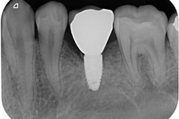 永久歯の先天欠如　インプラントによる補綴 治療後画像